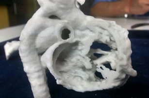 Детские хирурги в Индии используют 3D-печать в подготовке к сложным операциям на сердце