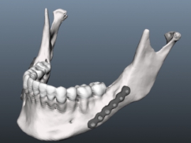 Как 3D-печать помогает восстанавливать челюсть после удаления опухоли