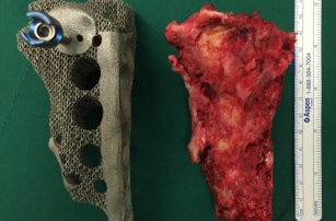Корейские врачи успешно имплантировали 3D-печатный таз