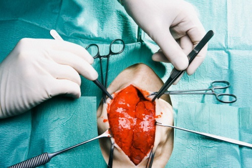 Технологии 3D-печати можно использовать при лечении сердечных пороков